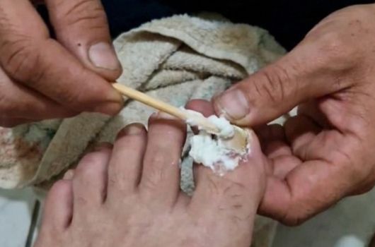 receita caseira para remover fungo da unha