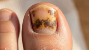 Causas e sintomas do fungo nas unhas