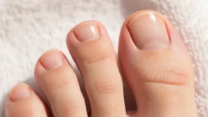 Causas do fungo nas unhas e como prevenir