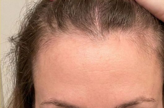 receita caseira para entradas no cabelo