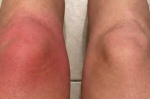 Método caseiro para dor no joelho: 10 opções seguras