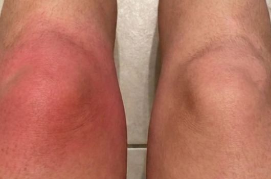 Método caseiro para dor no joelho: 10 opções seguras