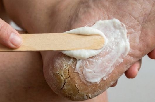 receita caseira para rachadura nos pés